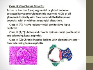 • Class III: Focal Lupus Nephritis
Active or inactive focal, segmental or global endo- or
extracapillary glomerulonephritis involving <50% of all
glomeruli, typically with focal subendothelial immune
deposits, with or without mesangial alterations.
Class III (A): Active lesions—focal proliferative lupus
nephritis
Class III (A/C): Active and chronic lesions—focal proliferative
and sclerosing lupus nephritis
Class III (C): Chronic inactive lesions with glomerular scars—
focal sclerosing lupus nephritis
 