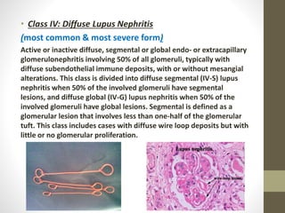 • Class IV: Diffuse Lupus Nephritis
(most common & most severe form)
Active or inactive diffuse, segmental or global endo- or extracapillary
glomerulonephritis involving 50% of all glomeruli, typically with
diffuse subendothelial immune deposits, with or without mesangial
alterations. This class is divided into diffuse segmental (IV-S) lupus
nephritis when 50% of the involved glomeruli have segmental
lesions, and diffuse global (IV-G) lupus nephritis when 50% of the
involved glomeruli have global lesions. Segmental is defined as a
glomerular lesion that involves less than one-half of the glomerular
tuft. This class includes cases with diffuse wire loop deposits but with
little or no glomerular proliferation.
 