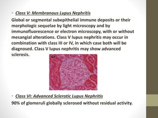 • Class V: Membranous Lupus Nephritis
Global or segmental subepithelial immune deposits or their
morphologic sequelae by light microscopy and by
immunofluorescence or electron microscopy, with or without
mesangial alterations. Class V lupus nephritis may occur in
combination with class III or IV, in which case both will be
diagnosed. Class V lupus nephritis may show advanced
sclerosis.
• Class VI: Advanced Sclerotic Lupus Nephritis
90% of glomeruli globally sclerosed without residual activity.
 