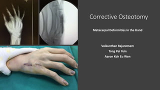 Corrective Osteotomy
Metacarpal Deformities in the Hand
Vaikunthan Rajaratnam
Tong Pei Yein
Aaron Koh Eu Wen
 