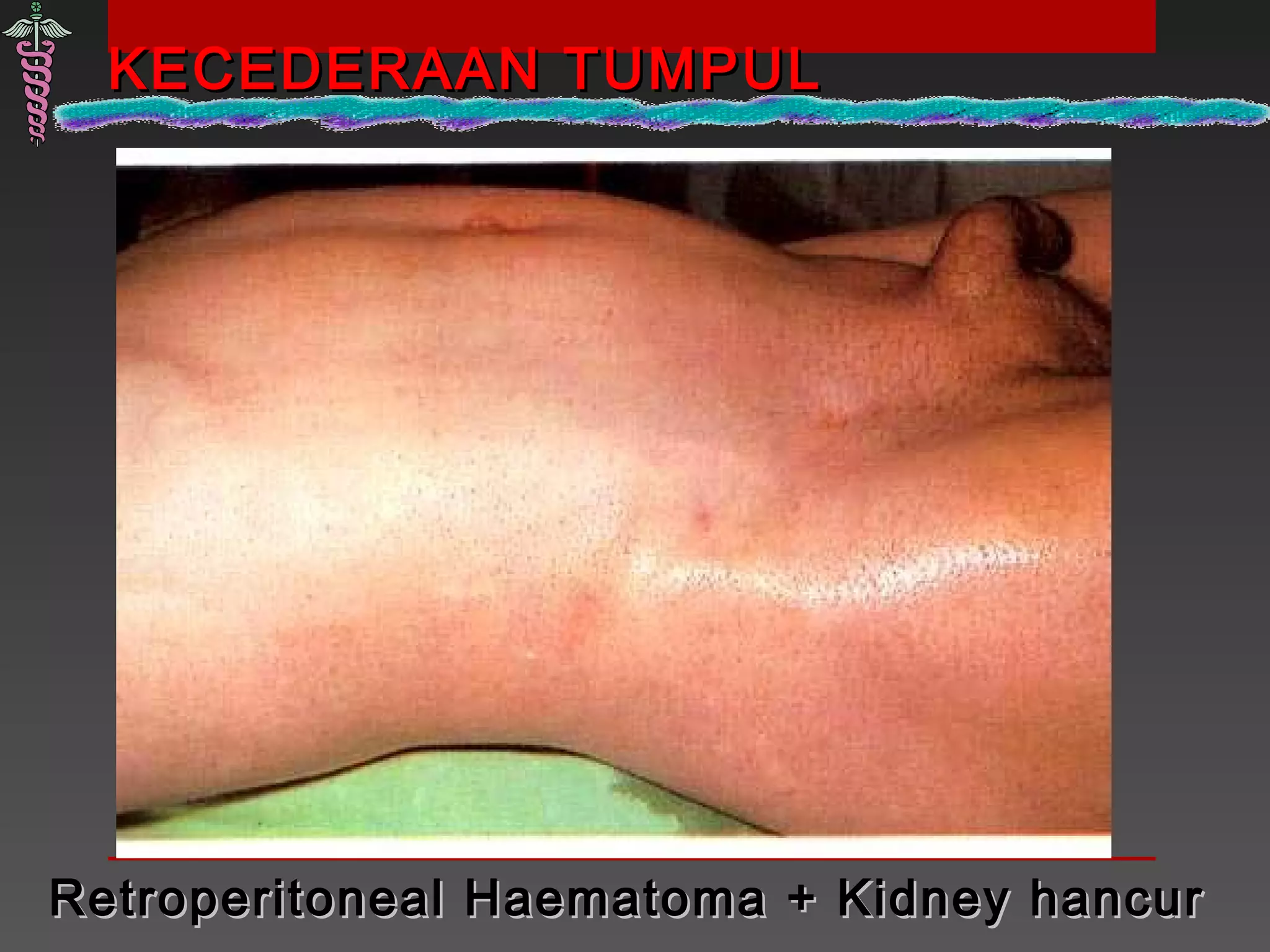 KECEDERAAN TUMPULKECEDERAAN TUMPUL
Retroperitoneal Haematoma + Kidney hancurRetroperitoneal Haematoma + Kidney hancur
 