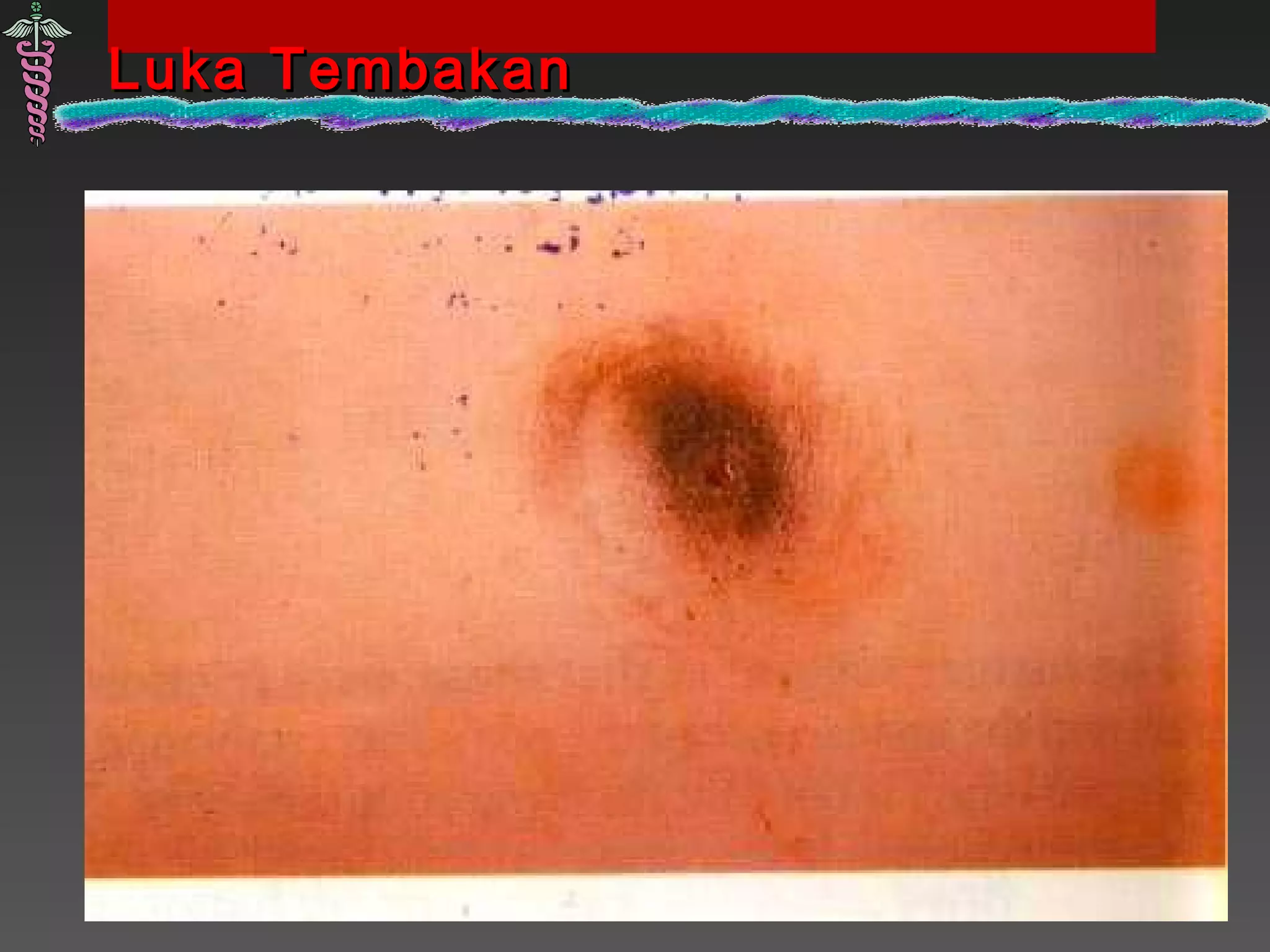 Luka TembakanLuka Tembakan
 