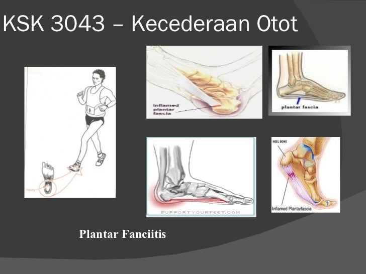 Kecederaan Otot