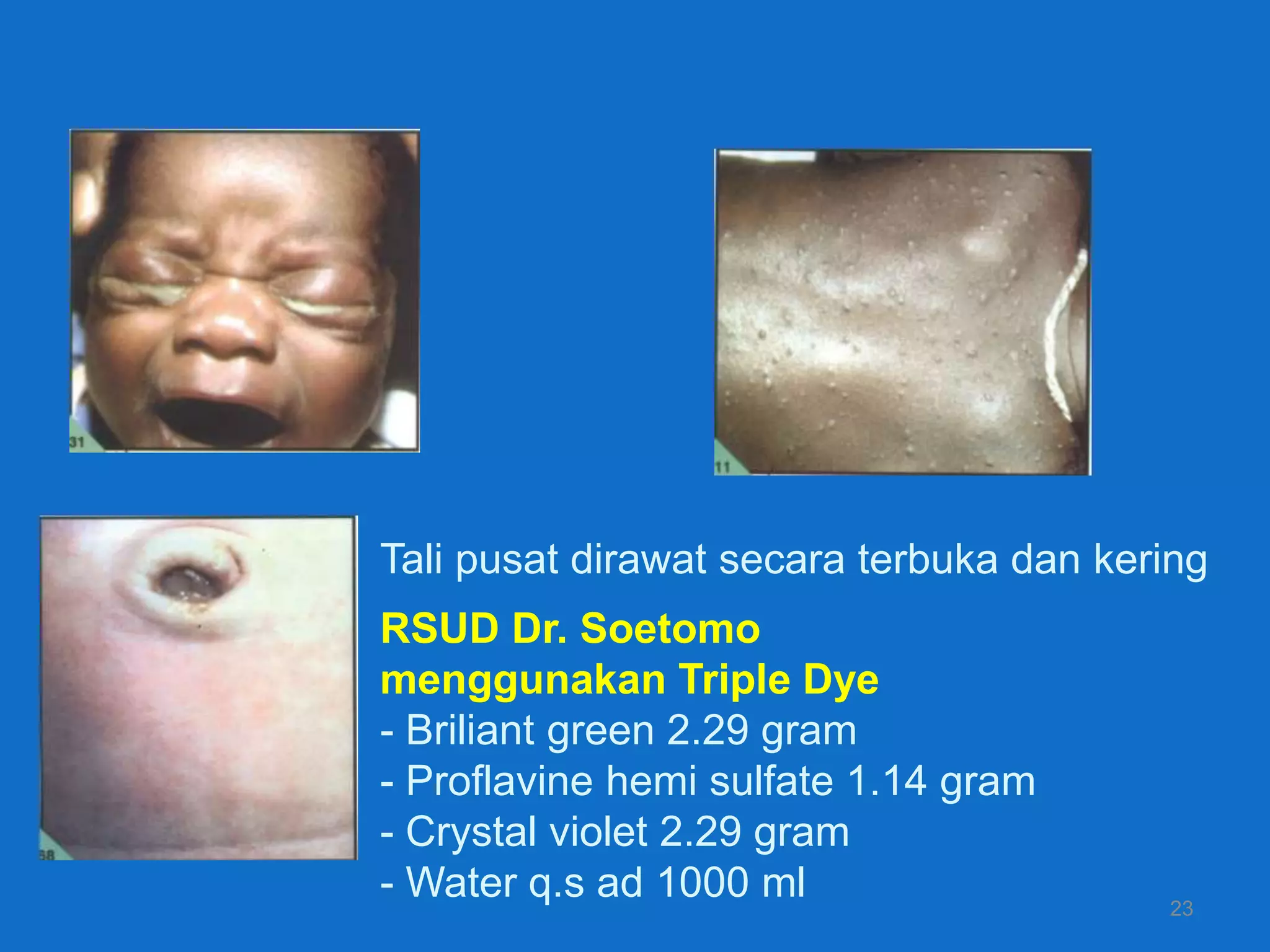 Tali pusat dirawat secara terbuka dan kering
RSUD Dr. Soetomo
menggunakan Triple Dye
- Briliant green 2.29 gram
- Proflavine hemi sulfate 1.14 gram
- Crystal violet 2.29 gram
- Water q.s ad 1000 ml                   23
 