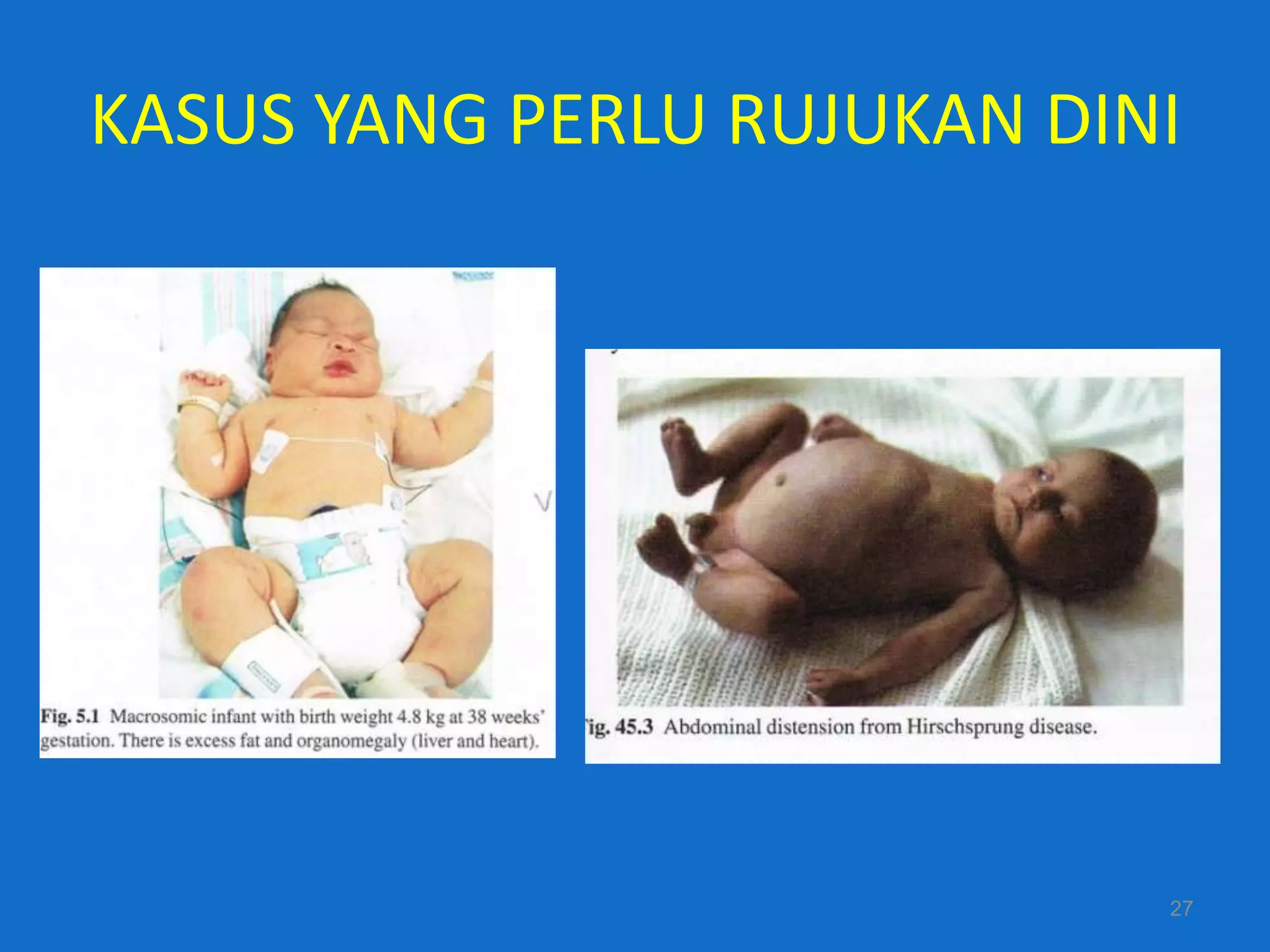 KASUS YANG PERLU RUJUKAN DINI




                            27
 