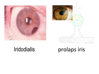 Iridodialis

prolaps iris

 