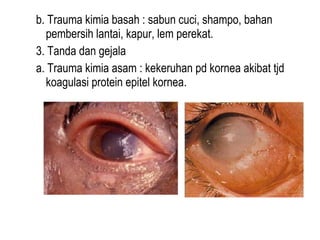 b. Trauma kimia basah : sabun cuci, shampo, bahan
pembersih lantai, kapur, lem perekat.
3. Tanda dan gejala
a. Trauma kimia asam : kekeruhan pd kornea akibat tjd
koagulasi protein epitel kornea.

 