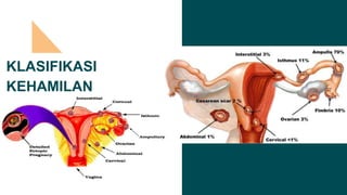 KLASIFIKASI
KEHAMILAN
EKTOPIK
 