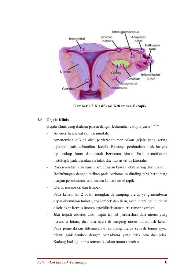 Kehamilan Ektopik Terganggu