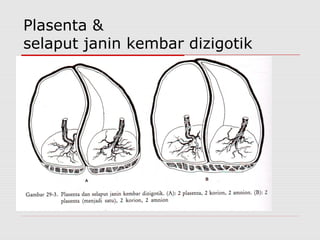 Plasenta &
selaput janin kembar dizigotik
 