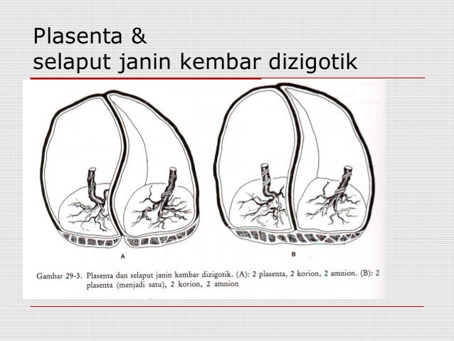 Contoh Kehamilan Gemelli