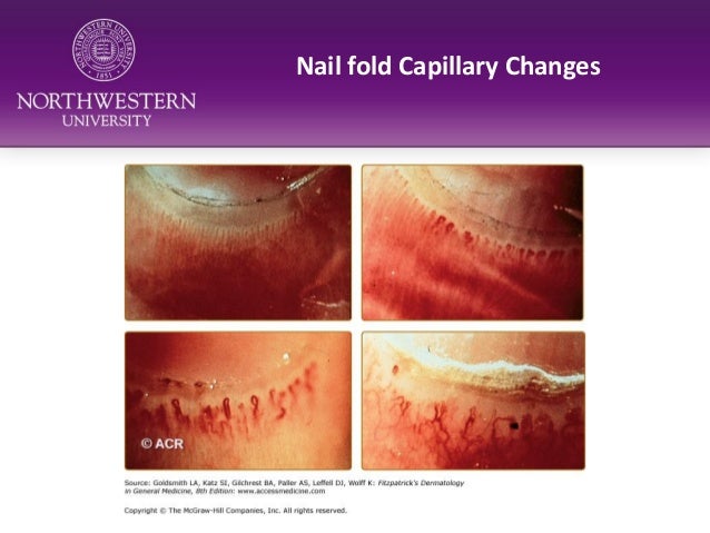 Skin Complications in Scleroderma