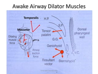 Awake Airway Dilator Muscles
© W. Keith Thornton DDS
Temporalis
Masseter
 