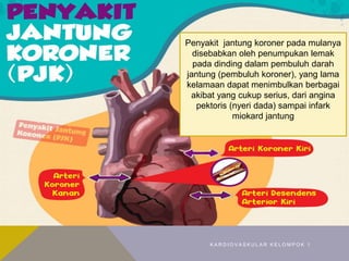 PENYAKIT JANTUNG KORONER (PJK)
K A R D I O V A S K U L A R K E L O M P O K 1
Penyakit jantung koroner pada mulanya
disebabkan oleh penumpukan lemak
pada dinding dalam pembuluh darah
jantung (pembuluh koroner), yang lama
kelamaan dapat menimbulkan berbagai
akibat yang cukup serius, dari angina
pektoris (nyeri dada) sampai infark
miokard jantung
 