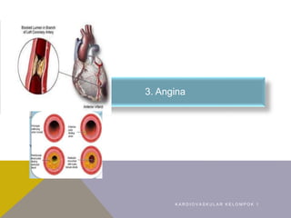 K A R D I O V A S K U L A R K E L O M P O K 1
3. Angina
 