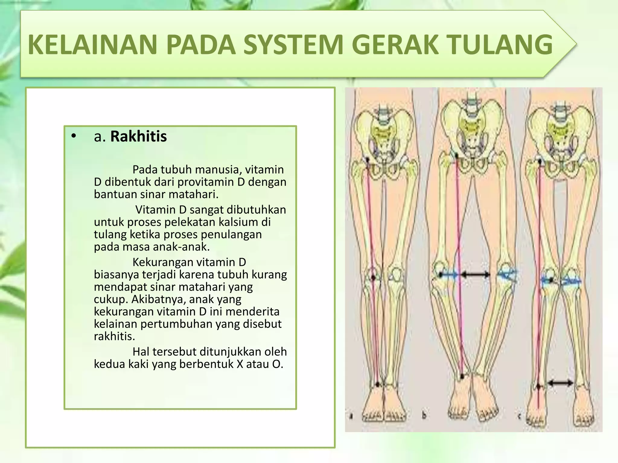 Kaki Rakhitis Kelainan dan penyakit pada sistem gerak manusia ppt.docx