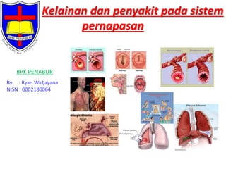 Kelainan dan penyakit pada sistem
pernapasan

BPK PENABUR
By : Ryan Widjayana
NISN : 0002180064

 