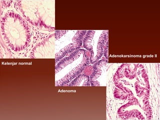 12
Kelenjar normal
Adenoma
Adenokarsinoma grade II
 