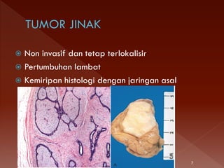 Non invasif dan tetap terlokalisir
 Pertumbuhan lambat
 Kemiripan histologi dengan jaringan asal
7
 
