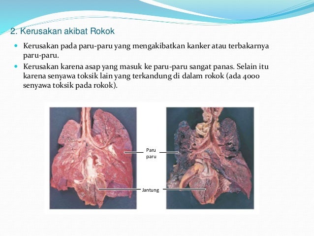 Kelainan Dan Penyakit Sistem Ekskresi Manusia