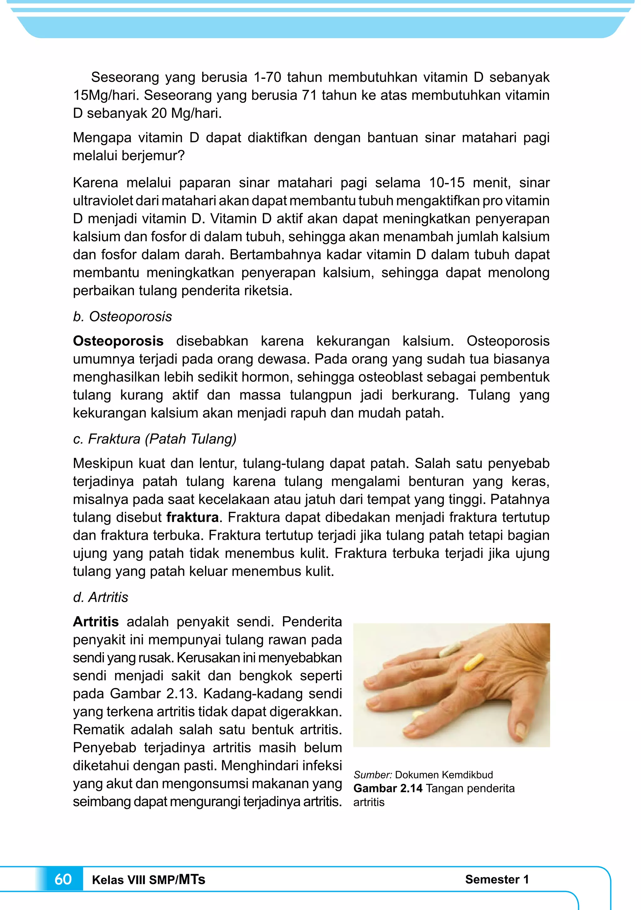 Kelas VIII SMP/MTs Semester 160
Seseorang yang berusia 1-70 tahun membutuhkan vitamin D sebanyak
15Mg/hari. Seseorang yang berusia 71 tahun ke atas membutuhkan vitamin
D sebanyak 20 Mg/hari.
Mengapa vitamin D dapat diaktifkan dengan bantuan sinar matahari pagi
melalui berjemur?
Karena melalui paparan sinar matahari pagi selama 10-15 menit, sinar
ultraviolet dari matahari akan dapat membantu tubuh mengaktifkan pro vitamin
D menjadi vitamin D. Vitamin D aktif akan dapat meningkatkan penyerapan
kalsium dan fosfor di dalam tubuh, sehingga akan menambah jumlah kalsium
dan fosfor dalam darah. Bertambahnya kadar vitamin D dalam tubuh dapat
membantu meningkatkan penyerapan kalsium, sehingga dapat menolong
perbaikan tulang penderita riketsia.
b. Osteoporosis
Osteoporosis disebabkan karena kekurangan kalsium. Osteoporosis
umumnya terjadi pada orang dewasa. Pada orang yang sudah tua biasanya
menghasilkan lebih sedikit hormon, sehingga osteoblast sebagai pembentuk
tulang kurang aktif dan massa tulangpun jadi berkurang. Tulang yang
kekurangan kalsium akan menjadi rapuh dan mudah patah.
c. Fraktura (Patah Tulang)
Meskipun kuat dan lentur, tulang-tulang dapat patah. Salah satu penyebab
terjadinya patah tulang karena tulang mengalami benturan yang keras,
misalnya pada saat kecelakaan atau jatuh dari tempat yang tinggi. Patahnya
tulang disebut fraktura. Fraktura dapat dibedakan menjadi fraktura tertutup
dan fraktura terbuka. Fraktura tertutup terjadi jika tulang patah tetapi bagian
ujung yang patah tidak menembus kulit. Fraktura terbuka terjadi jika ujung
tulang yang patah keluar menembus kulit.
d. Artritis
Artritis adalah penyakit sendi. Penderita
penyakit ini mempunyai tulang rawan pada
sendiyangrusak.Kerusakaninimenyebabkan
sendi menjadi sakit dan bengkok seperti
pada Gambar 2.13. Kadang-kadang sendi
yang terkena artritis tidak dapat digerakkan.
Rematik adalah salah satu bentuk artritis.
Penyebab terjadinya artritis masih belum
diketahui dengan pasti. Menghindari infeksi
yang akut dan mengonsumsi makanan yang
seimbang dapat mengurangi terjadinya artritis.
Sumber: Dokumen Kemdikbud
Gambar 2.14 Tangan penderita
artritis
 