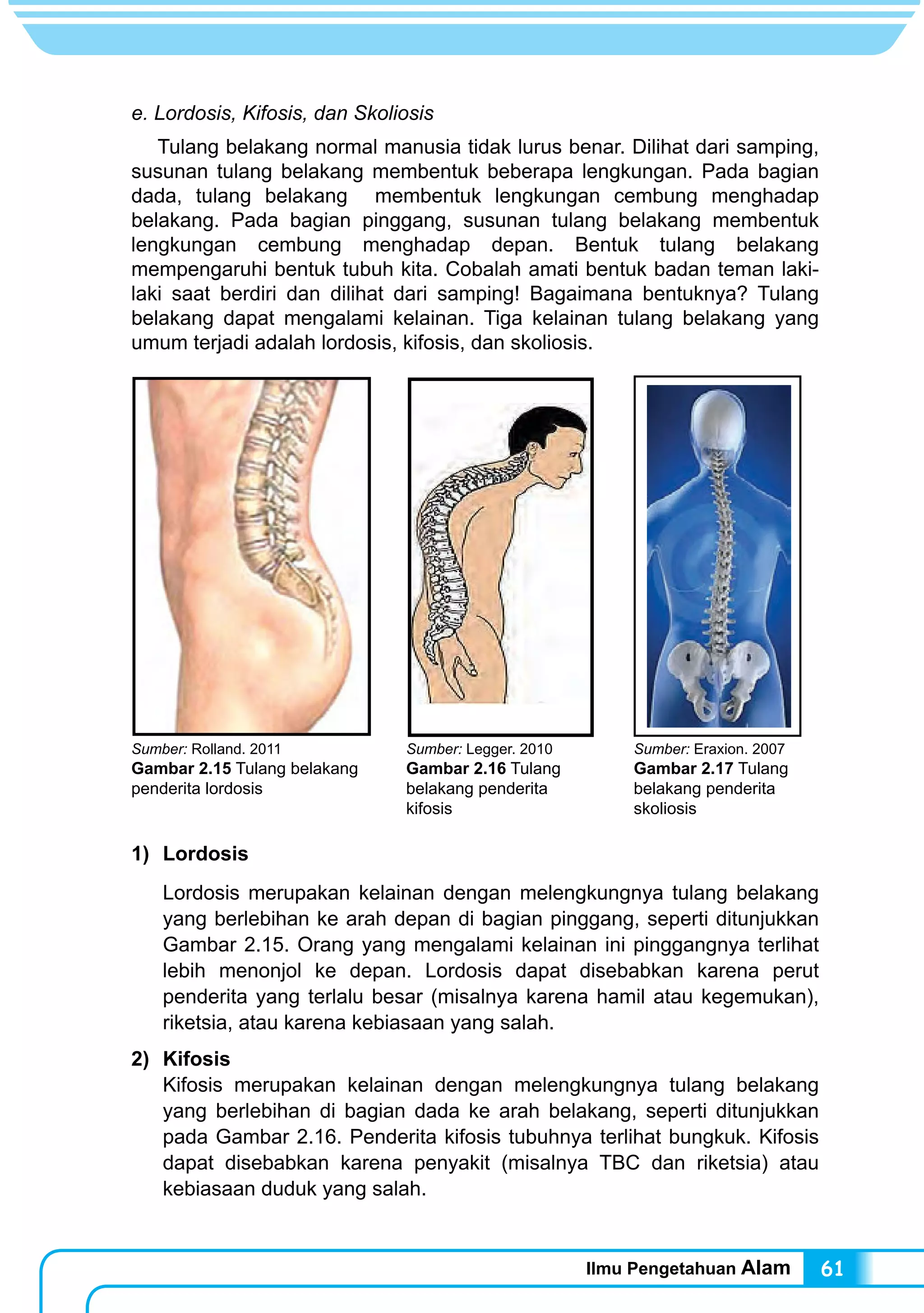 Ilmu Pengetahuan Alam 61
e. Lordosis, Kifosis, dan Skoliosis
Tulang belakang normal manusia tidak lurus benar. Dilihat dari samping,
susunan tulang belakang membentuk beberapa lengkungan. Pada bagian
dada, tulang belakang membentuk lengkungan cembung menghadap
belakang. Pada bagian pinggang, susunan tulang belakang membentuk
lengkungan cembung menghadap depan. Bentuk tulang belakang
mempengaruhi bentuk tubuh kita. Cobalah amati bentuk badan teman laki-
laki saat berdiri dan dilihat dari samping! Bagaimana bentuknya? Tulang
belakang dapat mengalami kelainan. Tiga kelainan tulang belakang yang
umum terjadi adalah lordosis, kifosis, dan skoliosis.
Sumber: Rolland. 2011
Gambar 2.15 Tulang belakang
penderita lordosis
Sumber: Legger. 2010
Gambar 2.16 Tulang
belakang penderita
kifosis
Sumber: Eraxion. 2007
Gambar 2.17 Tulang
belakang penderita
skoliosis
1) 	Lordosis
Lordosis merupakan kelainan dengan melengkungnya tulang belakang
yang berlebihan ke arah depan di bagian pinggang, seperti ditunjukkan
Gambar 2.15. Orang yang mengalami kelainan ini pinggangnya terlihat
lebih menonjol ke depan. Lordosis dapat disebabkan karena perut
penderita yang terlalu besar (misalnya karena hamil atau kegemukan),
riketsia, atau karena kebiasaan yang salah.
2) 	Kifosis
Kifosis merupakan kelainan dengan melengkungnya tulang belakang
yang berlebihan di bagian dada ke arah belakang, seperti ditunjukkan
pada Gambar 2.16. Penderita kifosis tubuhnya terlihat bungkuk. Kifosis
dapat disebabkan karena penyakit (misalnya TBC dan riketsia) atau
kebiasaan duduk yang salah.
 