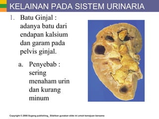 Copyright © 2008 Sugeng publishing_ Silahkan gunakan slide ini untuk kemajuan bersama
KELAINAN PADA SISTEM URINARIA
1. Batu Ginjal :
adanya batu dari
endapan kalsium
dan garam pada
pelvis ginjal.
a. Penyebab :
sering
menaham urin
dan kurang
minum
 