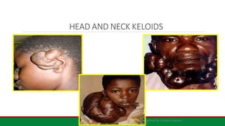 HEAD AND NECK KELOIDS
Adapted from Dr Achebe U lecture
note26
 