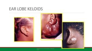 EAR LOBE KELOIDS
Adapted from Dr Achebe U lecture
note
27
 