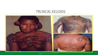TRUNCAL KELOIDS
28
Adapted from Dr Achebe U lecture
note
 