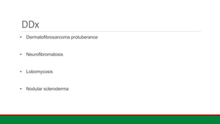 DDx
• Dermatofibrosarcoma protuberance
• Neurofibromatosis
• Lobomycosis
• Nodular scleroderma
 