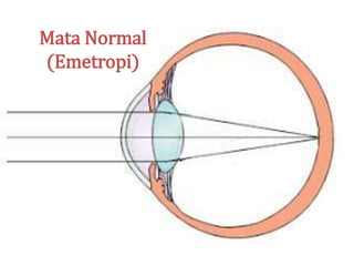 Mata Normal
(Emetropi)
 