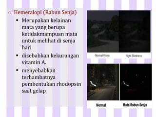 o Hemeralopi (Rabun Senja)
 Merupakan kelainan
mata yang berupa
ketidakmampuan mata
untuk melihat di senja
hari
 disebabkan kekurangan
vitamin A.
 menyebabkan
terhambatnya
pembentukan rhodopsin
saat gelap
 
