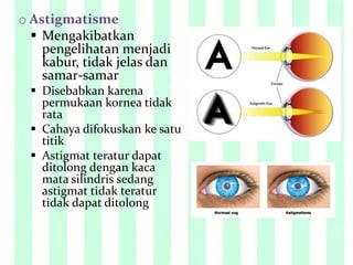 o Astigmatisme
 Mengakibatkan
pengelihatan menjadi
kabur, tidak jelas dan
samar-samar
 Disebabkan karena
permukaan kornea tidak
rata
 Cahaya difokuskan ke satu
titik
 Astigmat teratur dapat
ditolong dengan kaca
mata silindris sedang
astigmat tidak teratur
tidak dapat ditolong
 