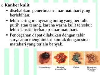 o Kanker kulit
 disebabkan penerimaan sinar matahari yang
berlebihan.
 lebih sering menyerang orang yang berkulit
putih atau terang, karena warna kulit tersebut
lebih sensitif terhadap sinar matahari.
 Pencegahan dapat dilakukan dengan tabir
surya atau menghindari kontak dengan sinar
matahari yang terlalu banyak.
 