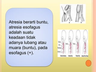 labioskiziz, labiospatokiziz dan atresia esopagus | PPTX