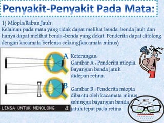 1) Miopia/Rabun Jauh : 
Kelainan pada mata yang tidak dapat melihat benda-benda jauh dan 
hanya dapat melihat benda-benda yang dekat. Penderita dapat ditolong 
dengan kacamata berlensa cekung(kacamata minus) 
Keterangan: 
Gambar A : Penderita miopia. 
Bayangan benda jatuh 
didepan retina. 
Gambar B : Penderita miopia 
dibantu oleh kacamata minus 
sehingga bayangan benda 
jatuh tepat pada retina 
A 
B 
 