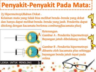 2) Hipermetropi/Rabun Dekat : 
Kelainan mata yang tidak bisa melihat benda-benda yang dekat 
dan hanya dapat melihat benda-benda yang jauh. Penderita dapat 
ditolong dengan kacamata berlensa cembung(kacamata plus) 
A 
B 
Keterangan: 
Gambar A : Penderita hipermetropi. 
Bayangan jatuh dibelakang retina 
Gambar B : Penderita hipermetropi 
dibantu oleh kacamata plus sehingga 
bayangan benda jatuh tepat pada 
retina 
 