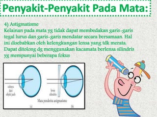 4) Astigmatisme 
Kelainan pada mata yg tidak dapat membedakan garis-garis 
tegal lurus dan garis-garis mendatar secara bersamaan. Hal 
ini disebabkan oleh kelengkungan lensa yang tdk merata. 
Dapat ditolong dg menggunakan kacamata berlensa silindris 
yg mempunyai beberapa fokus 
 