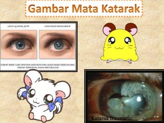 Katarak traumatic 
 