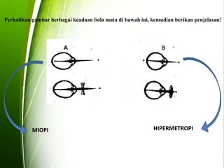 Perhatikan gambar berbagai keadaan bola mata di bawah ini, kemudian berikan penjelasan! 
MIOPI HIPERMETROPI 
 