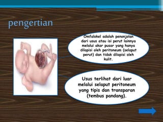 pengertian 
Omfalokel adalah penonjolan 
dari usus atau isi perut lainnya 
melalui akar pusar yang hanya 
dilapisi oleh peritoneum (selaput 
perut) dan tidak dilapisi oleh 
kulit. 
Usus terlihat dari luar 
melalui selaput peritoneum 
yang tipis dan transparan 
(tembus pandang). 
 