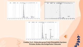 Gambar 2A-C. Elektroforegram Fraksi Hemoglobin Spesimen
Pertama, Kedua, dan KetigaPasien Talasemia
 