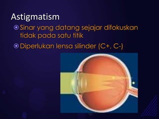 Astigmatism
 Sinar yang datang sejajar difokuskan
  tidak pada satu titik
 Diperlukan lensa silinder (C+, C-)
 
