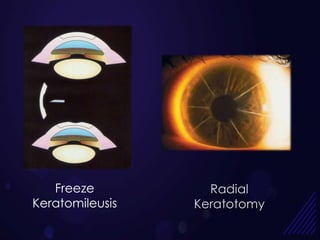 Freeze          Radial
Keratomileusis   Keratotomy
 