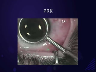 PRK
 