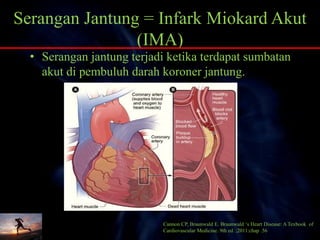 Serangan Jantung = Infark Miokard Akut
(IMA)
• Serangan jantung terjadi ketika terdapat sumbatan
akut di pembuluh darah koroner jantung.
Cannon CP, Braunwald E. Braunwald ‘s Heart Disease: A Texbook of
Cardiovascular Medicine. 9th ed. ;2011:chap .56
 