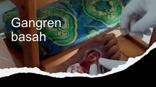 Gangren
basah