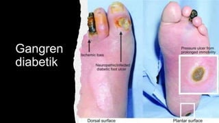 Gangren
diabetik
