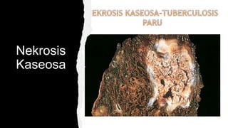 Nekrosis
Kaseosa